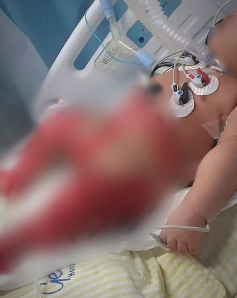 Morre bebê de seis meses que sofreu queimaduras em banho no Hospital Getulinho, em Niterói