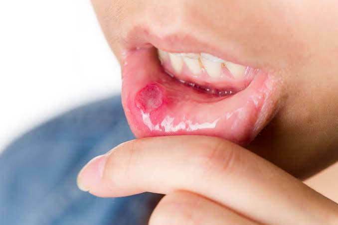 Maricá inicia campanha de prevenção ao câncer de boca